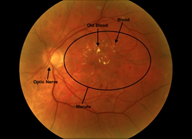 Diabetic Macular Edema Care | Retinal Consultants Medical Group