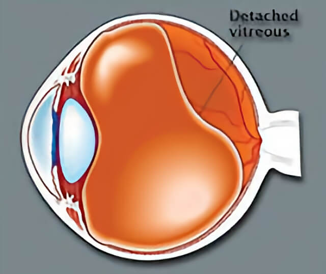 eye-flashes-floater-treatment-retinal-consultants-medical-group