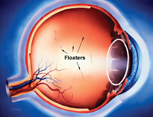 eye-flashes-floater-treatment-retinal-consultants-medical-group