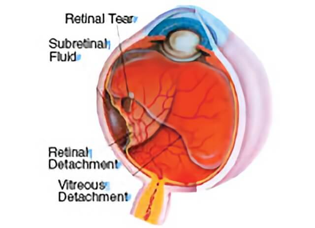 Vitreous Separation - Retina Vitreous Consultants, Inc