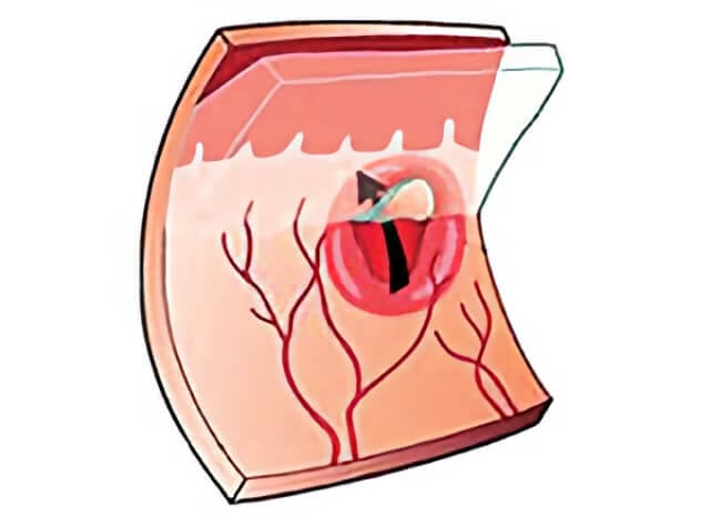 Retinal Tear Surgery  Retinal Consultants Medical Group