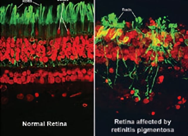 Retinitis Pigmentosa Treatment | Retinal Consultants Medical Group