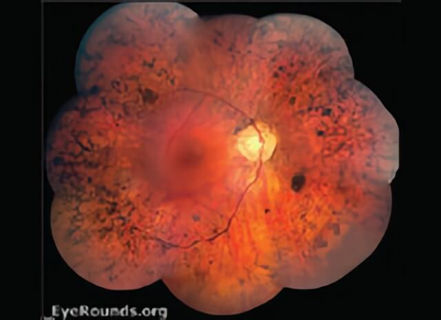 retinitis pigmentoza tedavisi