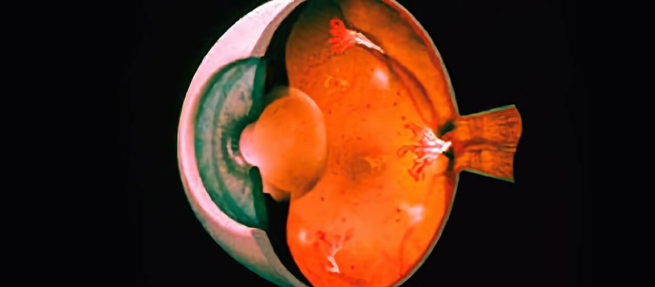 Panretinal Photocoagulation Retinal Consultants Medical Group