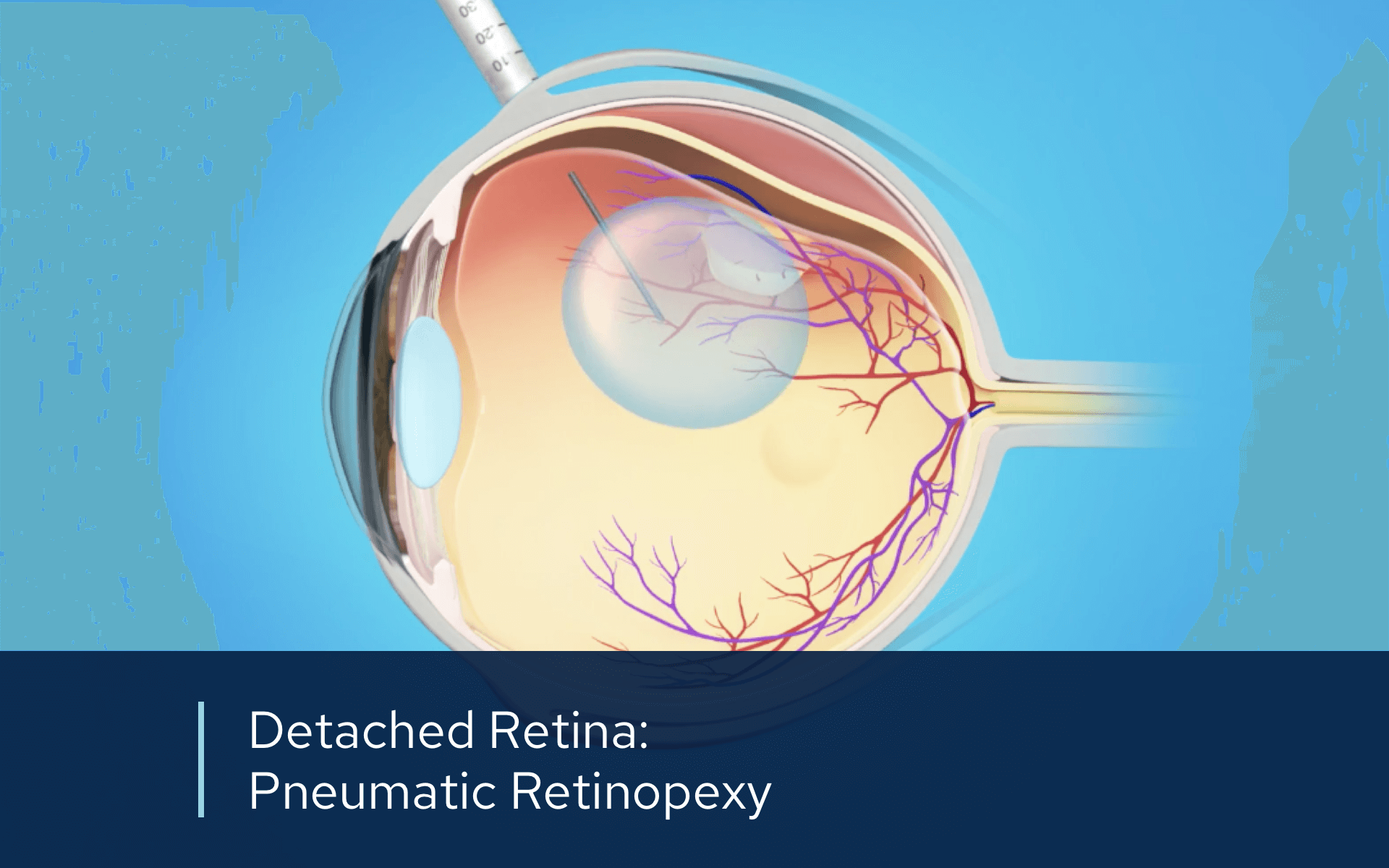 Retinal Videos | Retinal Consultants Medical Group