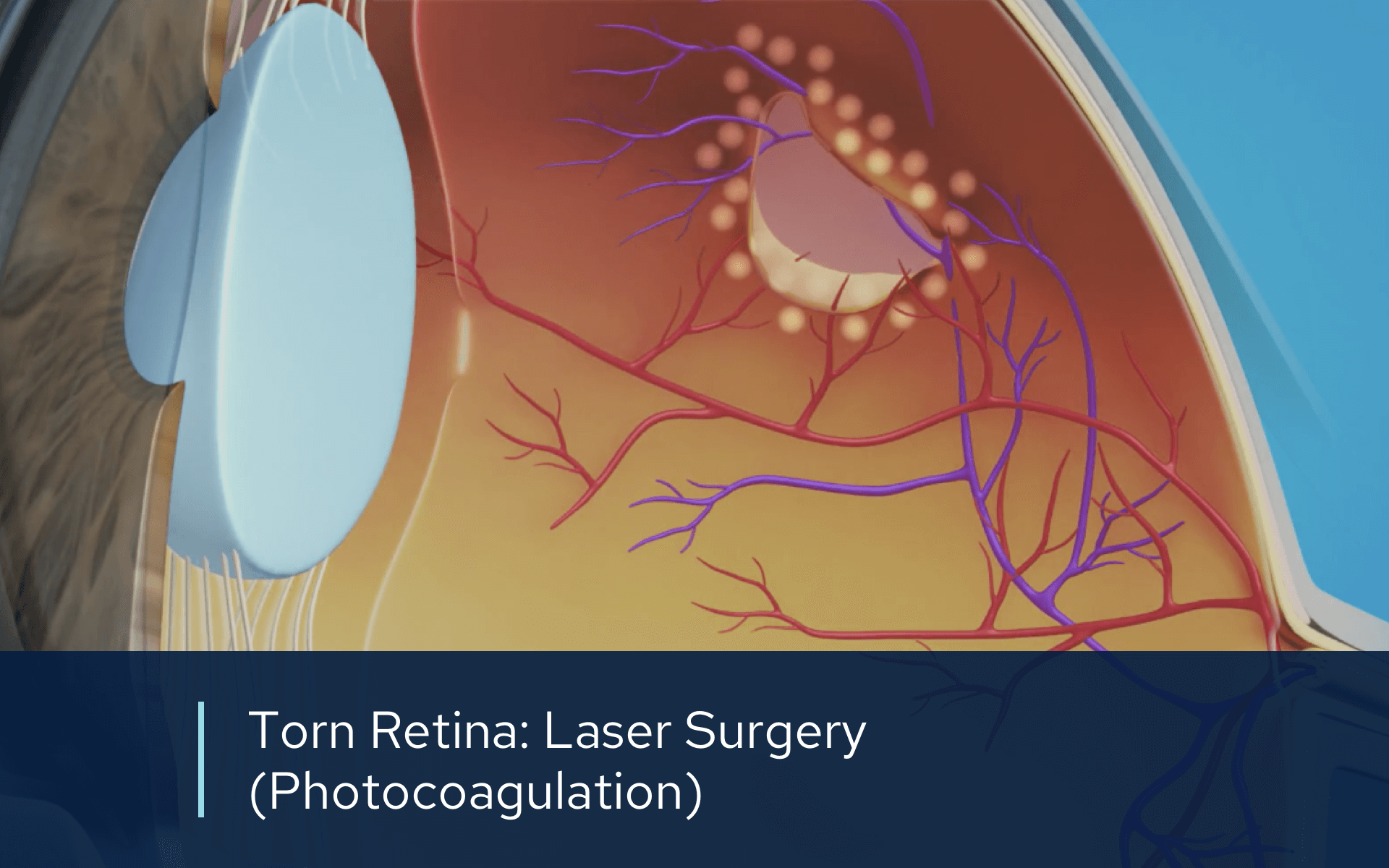 Retinal Videos | Retinal Consultants Medical Group